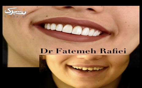 جراحی دندان عقل نسج نرم در دندانپزشکی دکتر رفیعی