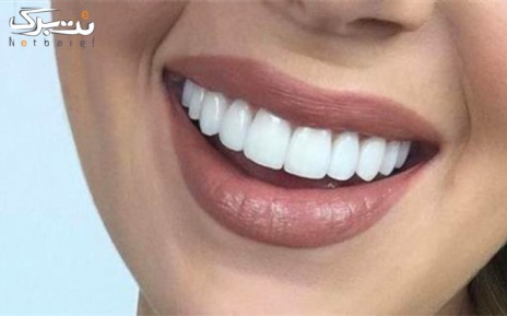 کامپوزیت یک سطحی در مرکز دندانپزشکی آران