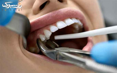 کشیدن دندان در دندانپزشکی دکتر گودرزی