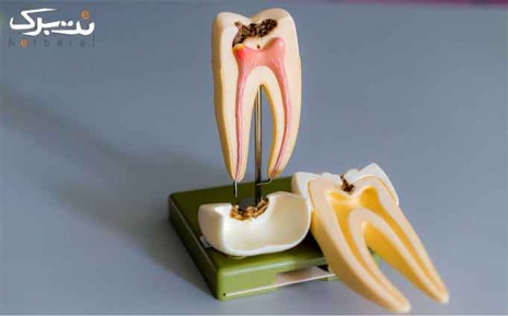درمان ریشه تک کانال در دندانپزشکی دکتر گودرزی