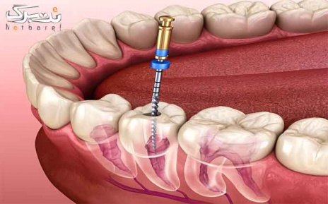 درمان ریشه ۳ و ۴ کانال در دندانپزشکی دکتر گودرزی