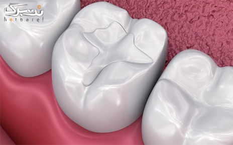 پرکردن دندانی دو سطحی با مواد آمالگام تحت لیسانس