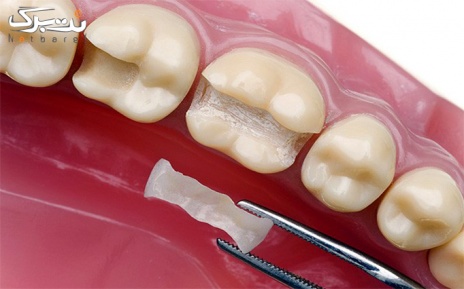 پرکردن دندانی یک سطحی با مواد آمالگام تحت لیسانس