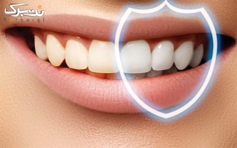 بلیچینگ با مواد ایتالیایی در مرکز دندانپزشکی بهنوش
