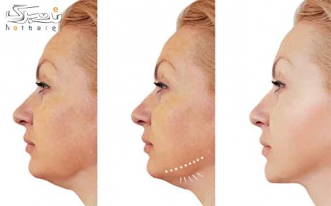 مزونیدلینگ صورت یا گردن در مطب دکتر سهرابی