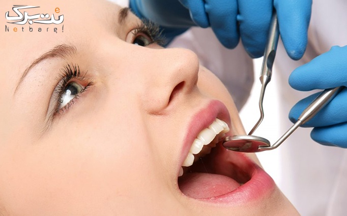 لمینت کامپوزیت دندان در دندانپزشکی دکتر قنادی