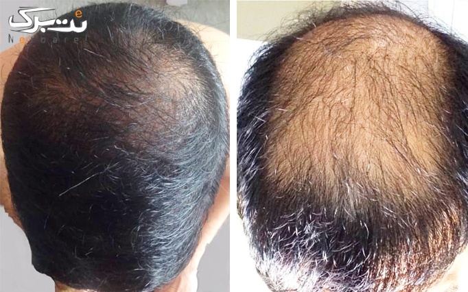 کاشت مو و ابروی طبیعی در مطب دکتر حقایقی