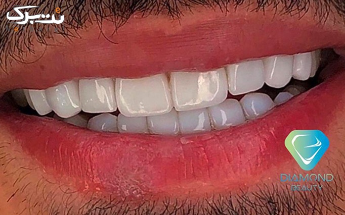 پلیش دندان در دندانپزشکی دایموند