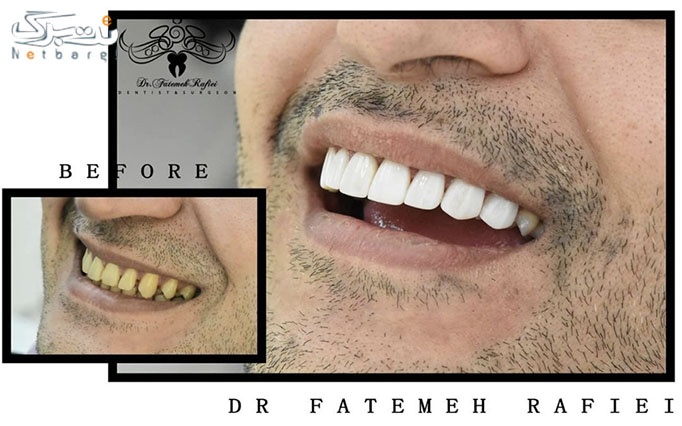 ترمیم آمالگام یک سطحی در دندانپزشکی دکتر رفیعی