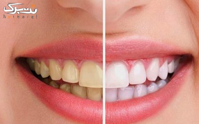 کشیدن دندان عقل معمولی در مرکز دندانپزشکی آران