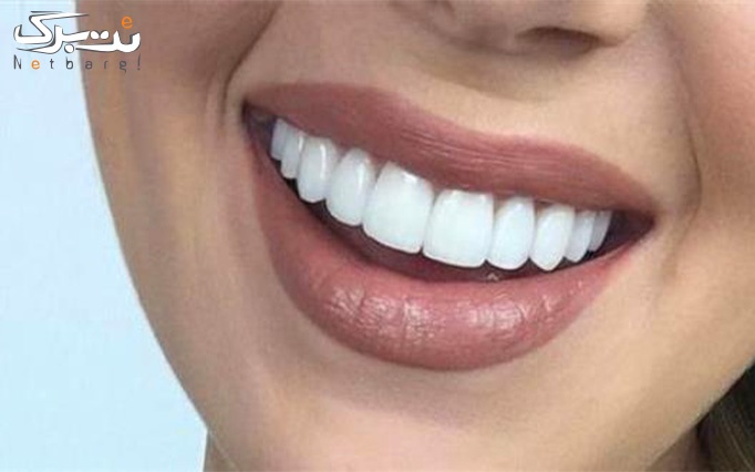 ایمپلنت کره ای در دندانپزشکی مرسی