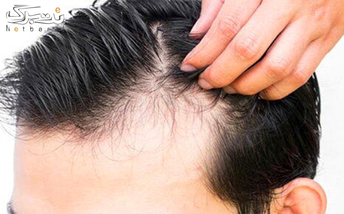 درمان ریزش مو در کلینیک شیرین بیوتی