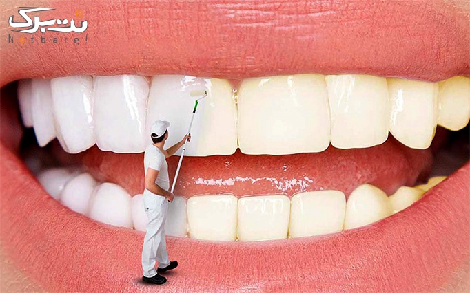 خدمات زیبایی دندان در مطب دندانپزشکی دکتر کاشانی