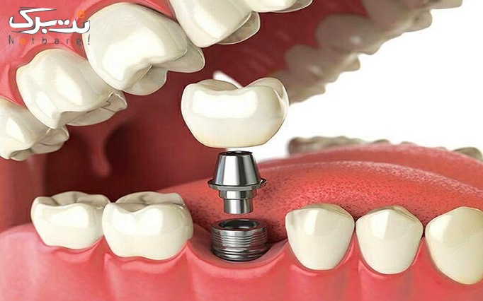 ایمپلنت سویسی در دندانپزشکی مرسی