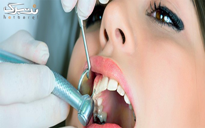 عصب کشی در مرکز دندانپزشکی دنتال آبی