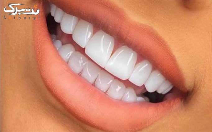کامپوزیت در دندانپزشکی الماس رودهن