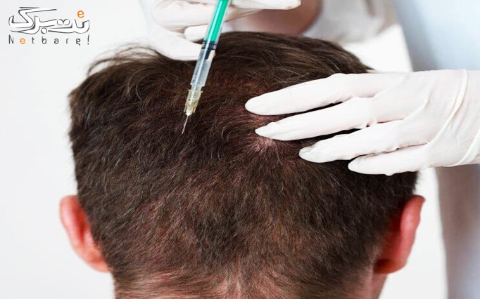 مزوتراپی موی سر در مرکز پزشکی مهر آفرین