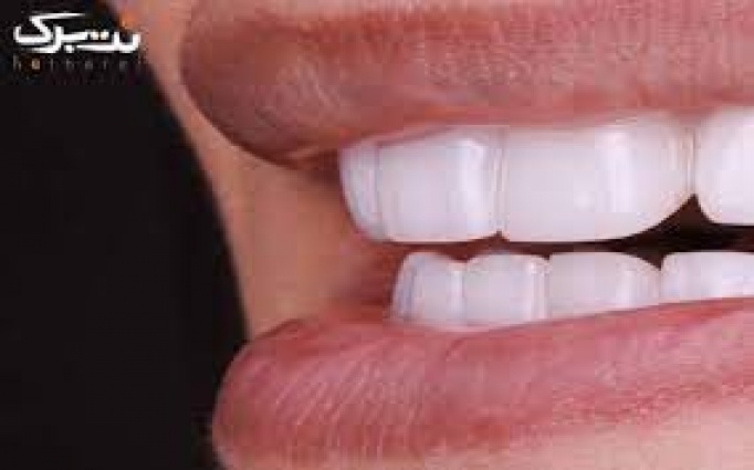 روکش دندان بدون فلز در مطب دندانپزشکی دکتر عبدی