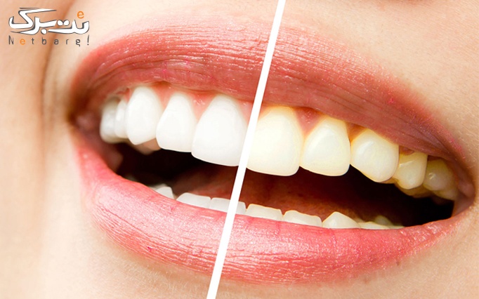 کامپوزیت تک سطحی در دندانپزشکی اسمایل سنتر