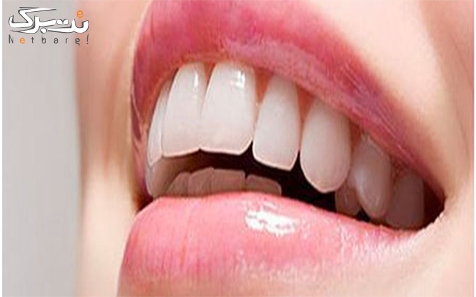 لمینیت دندان در مطب دندانپزشکی دکتر شیخی