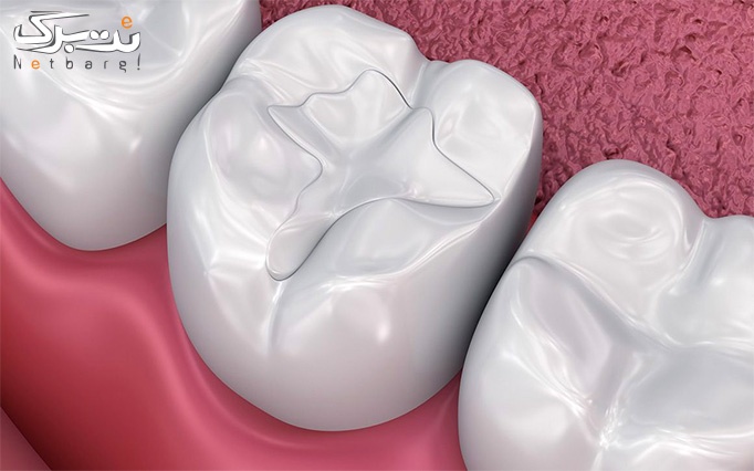 ترمیم دندان در مجموعه میردنتال