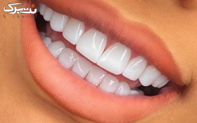لمینیت ips در دندانپزشکی دکتر کثیری