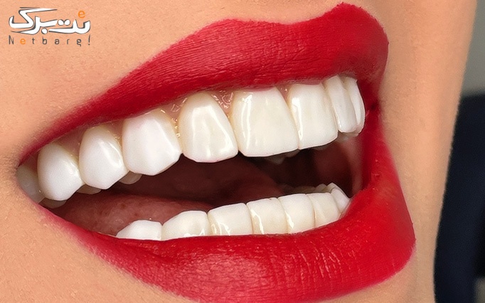 کشیدن دندان خلفی کلینیک دکتر مانا توسلی خواه