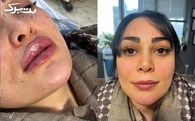 بوتاکس مصپورت در کلینیک زیبایی دکتر فتحی