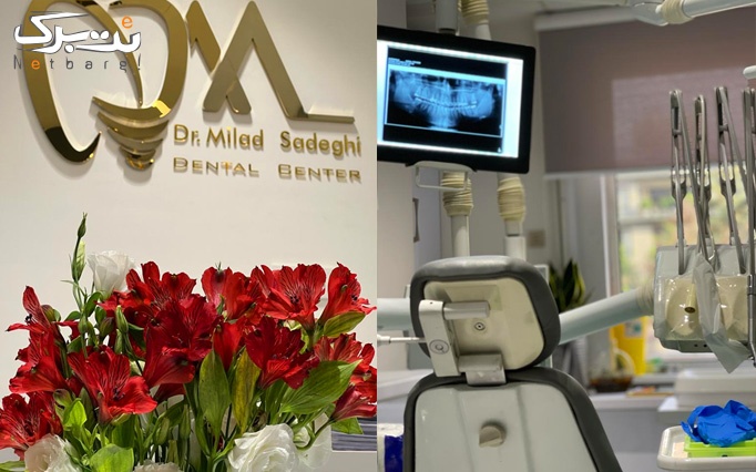روکش دندان در مطب دکتر میلاد صادقی