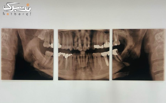 کشیدن دندان عقل در دندانپزشکی دکتر قشقایی