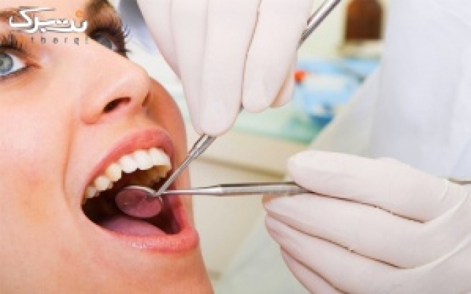 روکش دندان PFM در دندانپزشکی دکترفخر طباطبایی