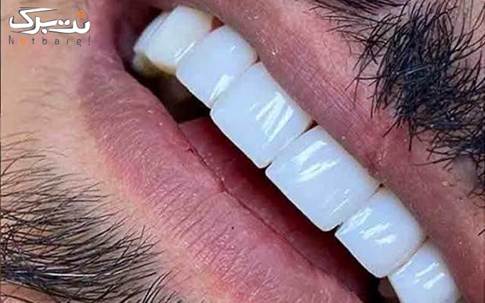 ونیر کامپوزیت سوئیسی در مطب دندانپزشکی قلهک