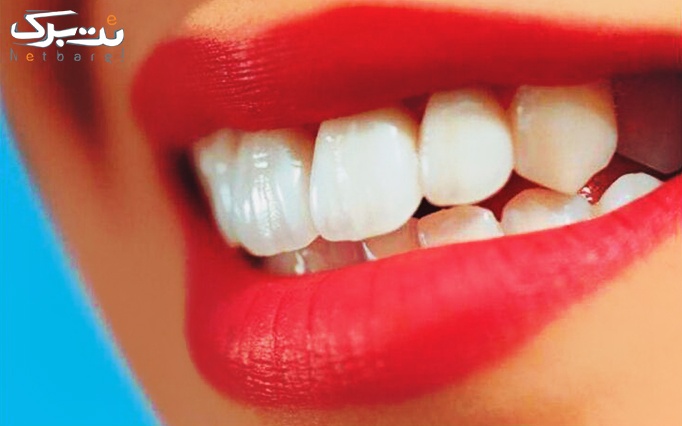 جرمگیری دندان دردندانپزشکی شهرتاش