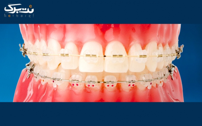 پیش پرداخت ارتودنسی توسط متخصص در مطب دندانپزشکی دکتر عشاق 