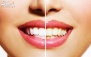 جرمگیری دندان و بلیچینگ دندان در مطب دکترامامی نسب