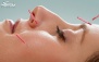 طب سوزنی برای جوانسازی صورت در کلینیک مهتاب شمیران 