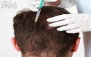مزوتراپی موی سر در مطب پزشک