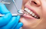 کامپوزیت ونیر هر واحد دندان در مطب دکتر فاطمه عبدی