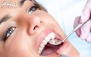 کشیدن دندان شیری در مرکز دندانپزشکی اشرفی