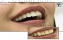 ترمیم آمالگام یک سطحی در دندانپزشکی دکتر رفیعی
