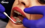 ترمیم یک سطحی دندان در کلینیک دندانپزشکی آراد طب