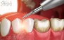 جرم گیری و بروساژ کامل دو فک در مرکز دندانپزشکی دی