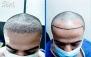 کاشت مو و ابرو در کلینیک فوق تخصصی دیبا