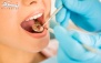 عصب کشی دندان در مطب دندانپزشکی دکتر اقتصادی