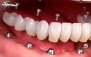 ایمپلنت با روکش زیرکونیا در دندانپزشکی دکتر برزگر