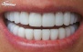 فیشور سیلنت و ترمیم دندان در مطب دکتر افشاری