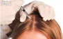 مزوتراپی موی سر در مرکز درمانی میکال