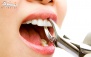 کشیدن دندان تک ریشه در دندانپزشکی دکتر دایر