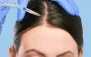 مزوتراپی برای ریزش مو در مرکز پوست و مو‌ مهتاب