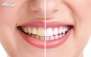 ترمیم دندان یک سطحی در دندانپزشکی لبخند